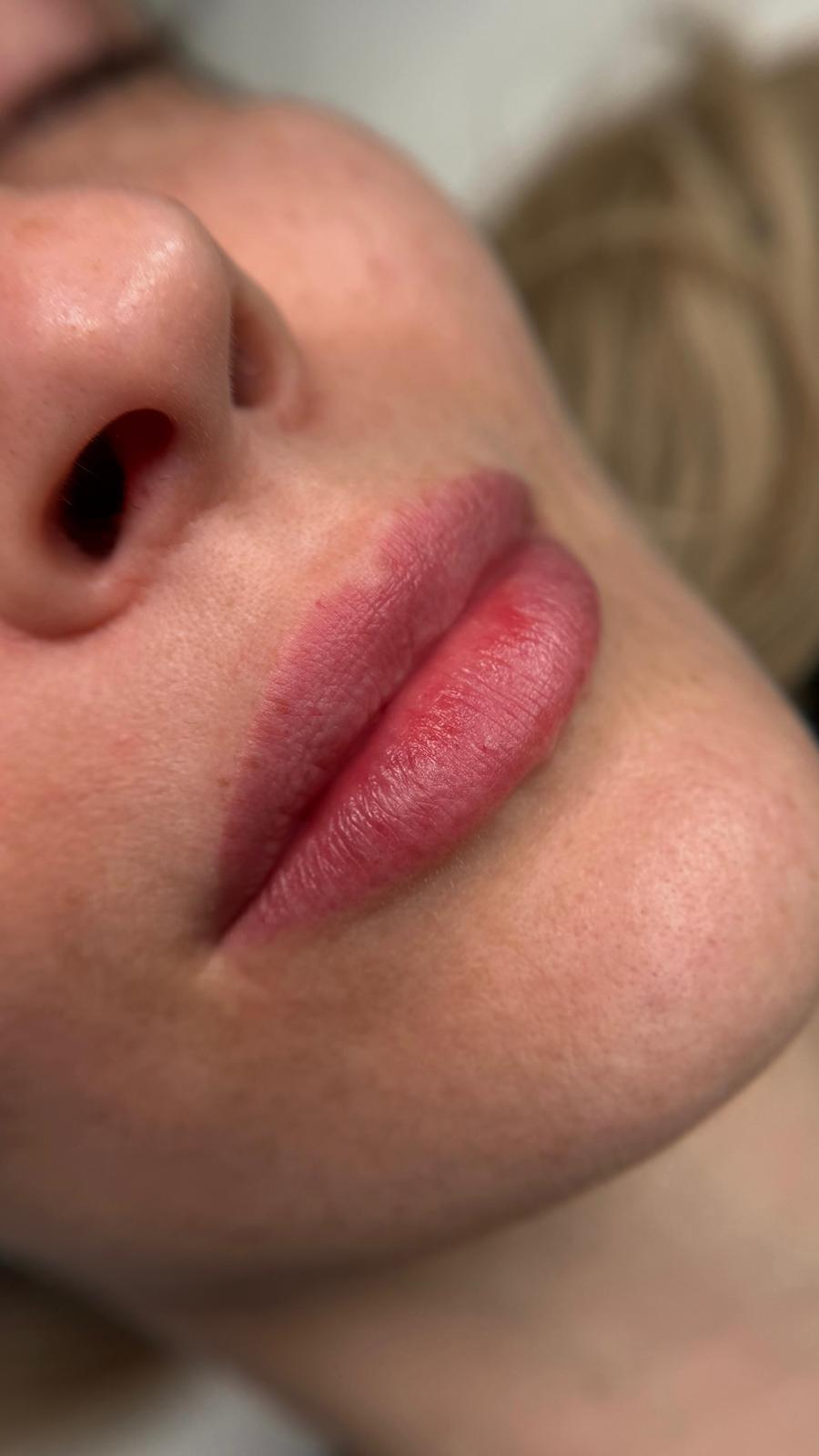 3D Lips abgeheilt, natürliches Endergebnis