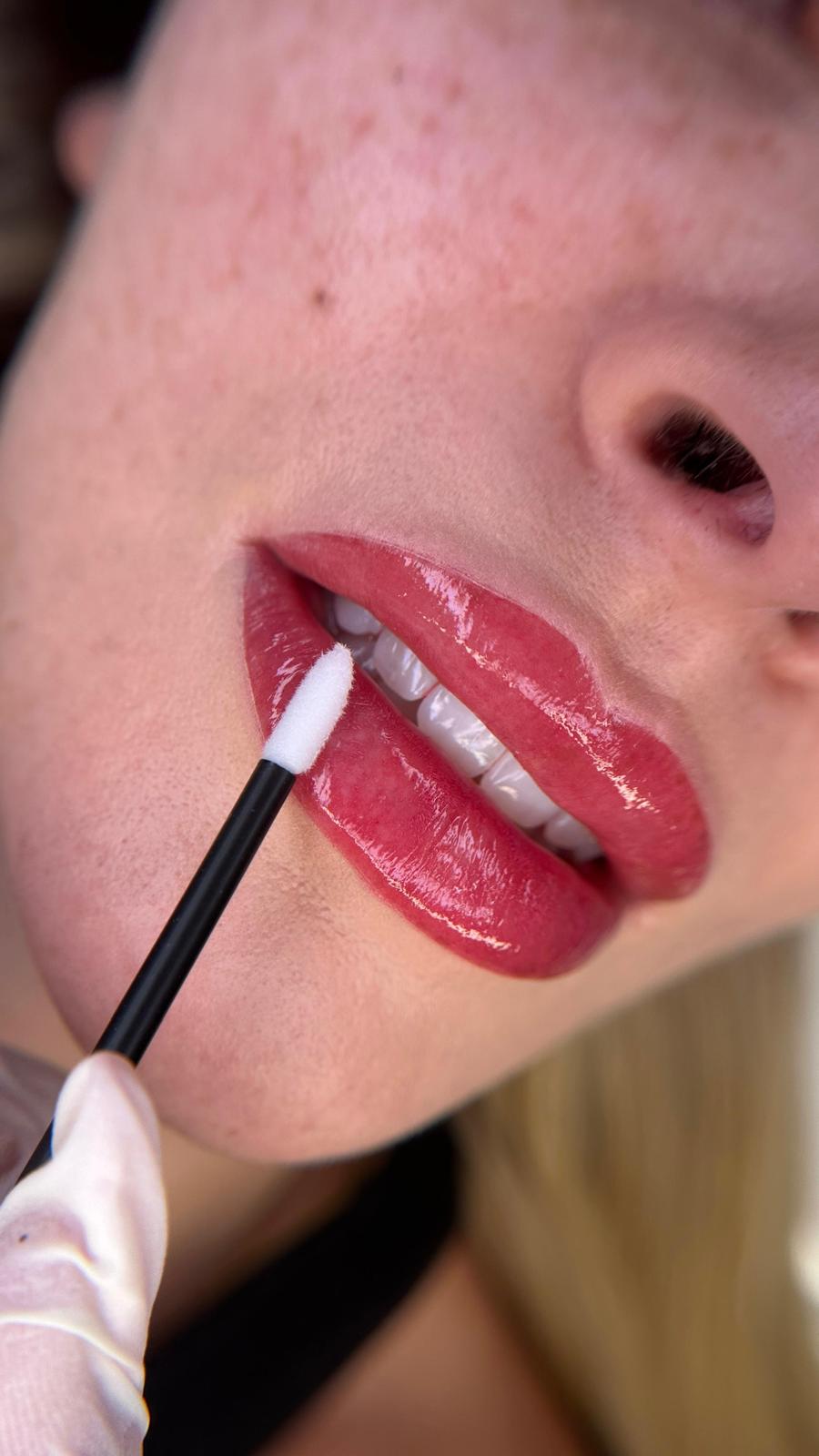 3D Lips direkt nach der Behandlung, frisch gestochen